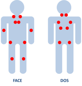 Les points de douleurs de la fibromyalgie