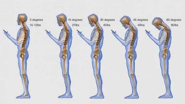 Etude sur Mauvaise posture douleurs cervicales migraines