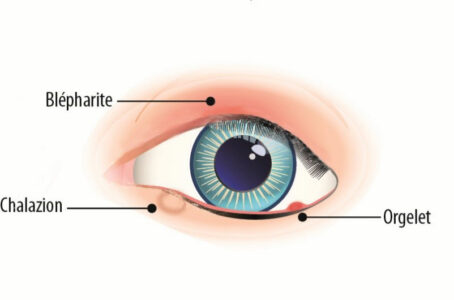 blepharite-orgelet-chalazion-difference