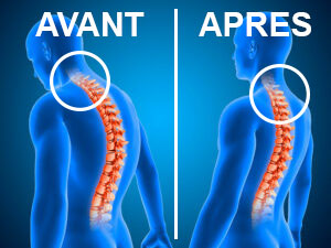 effets-traction-cervicale-climsom-flex-avant-apres